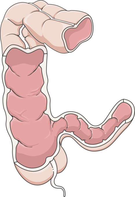 Hình ảnh cắt lớp minh họa đại tràng bị bệnh Crohn với các vết loét và niêm mạc bị viêm nhiễm.