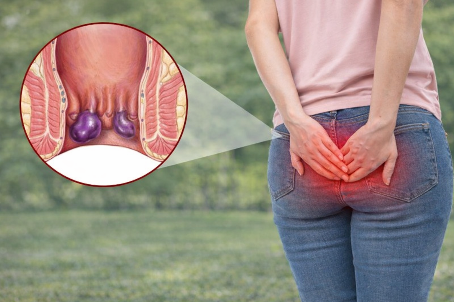 Hình ảnh mô phỏng cấu trúc mụn nhọt và áp xe ngoài da