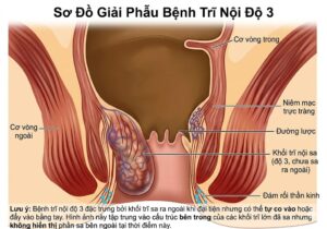 Sơ đồ giải phẫu bệnh trĩ nội độ 3 hiển thị chi tiết khối trĩ sa, cơ vòng, niêm mạc trực tràng và đám rối thần kinh.