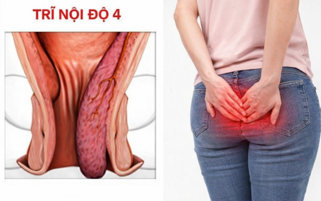 Tại sao búi trĩ không tự co lên được? Giải đáp từ chuyên gia tại Tuyên Quang
