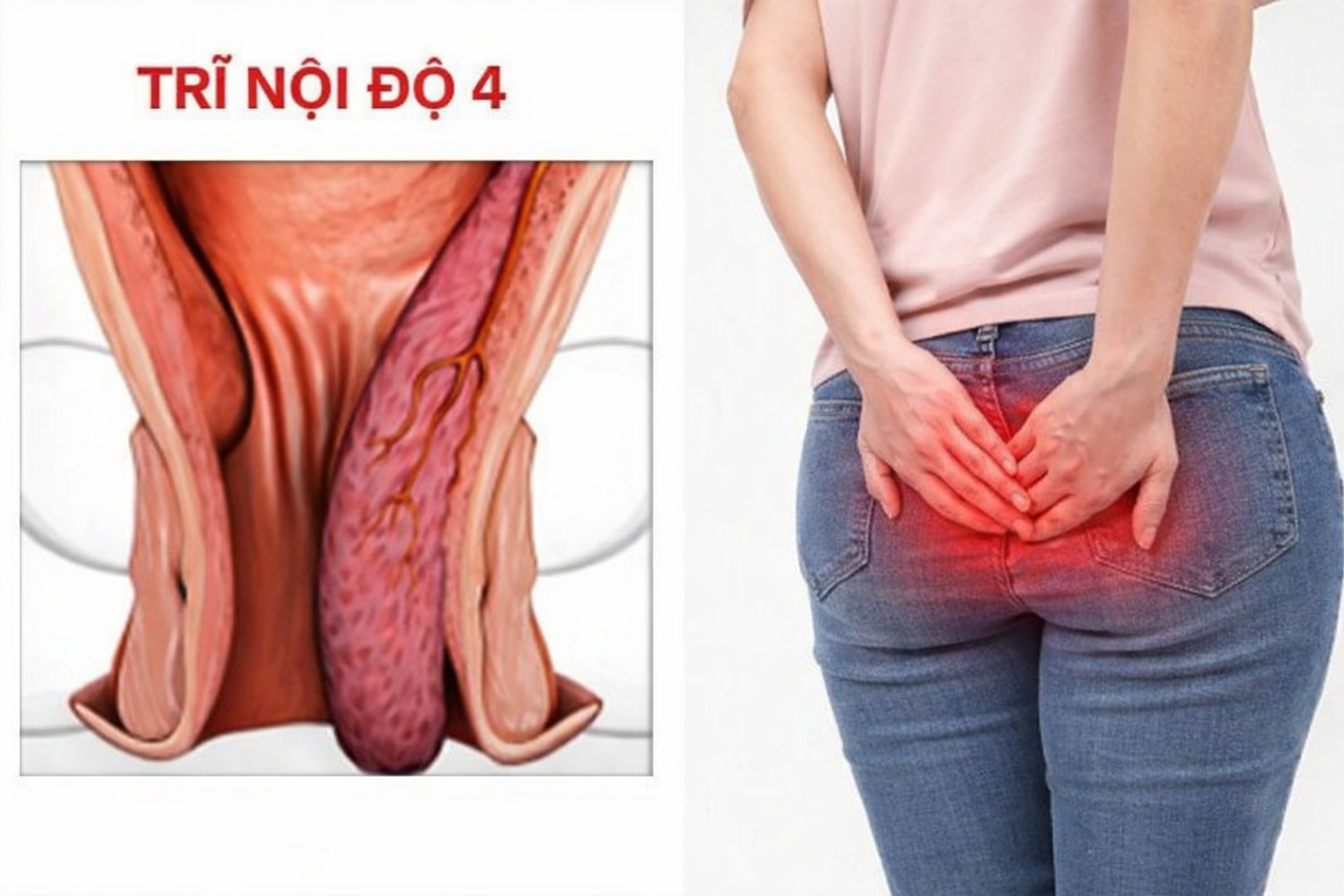 Minh họa bệnh trĩ nội độ 4 với búi trĩ sa hẳn ra ngoài hậu môn và hình ảnh người bệnh đau nhức dữ dội.
