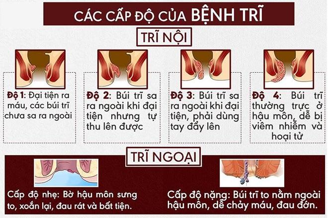 Bảng phân loại 4 cấp độ trĩ nội và các cấp độ trĩ ngoại.